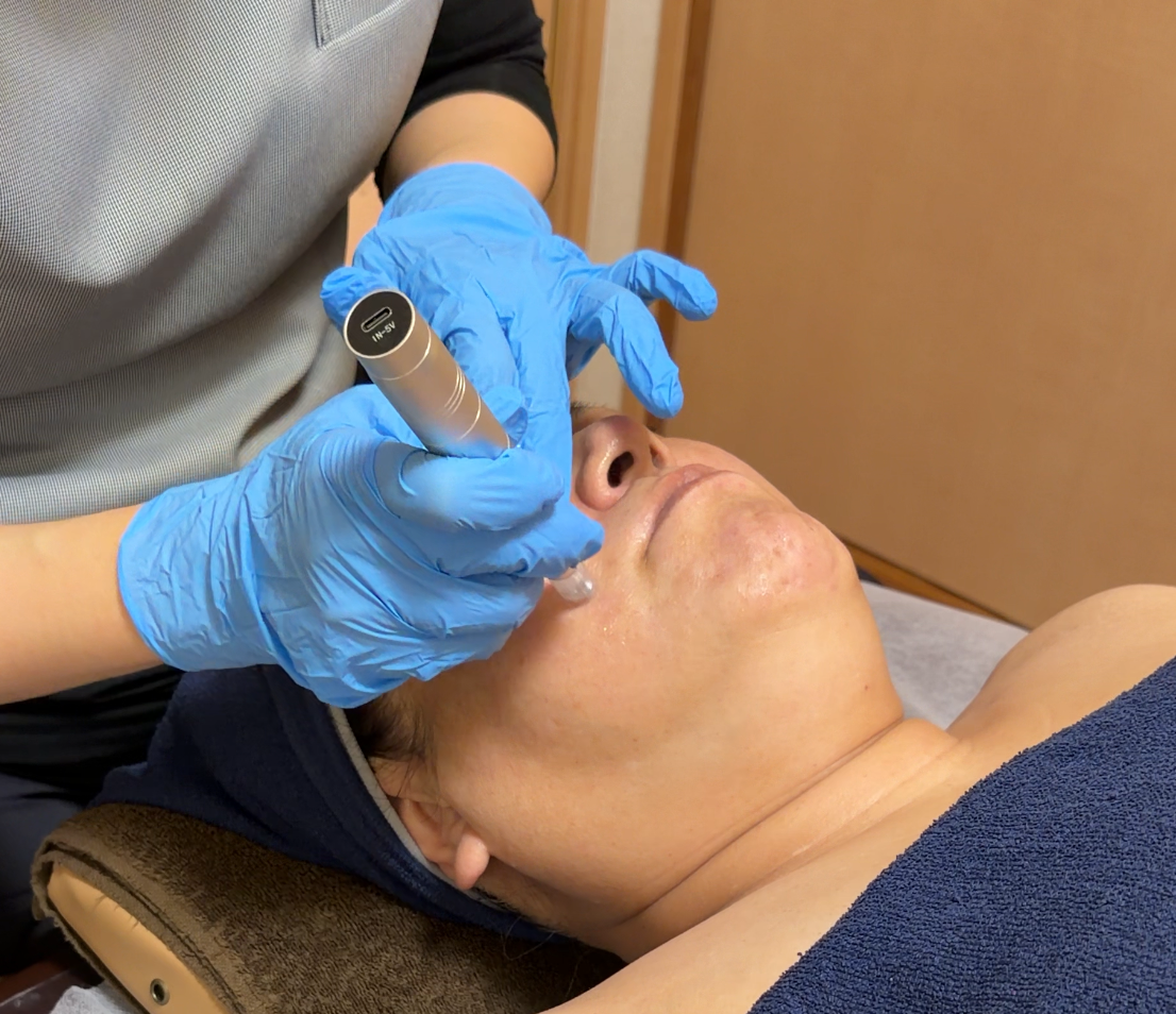 肌再生マイクロニードルケア（MTS）施術イメージ